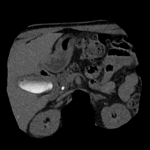 File:Normal CT intravenous cholangiogram (Radiopaedia 38199-40208 Axial IVC (MIP) 37).png