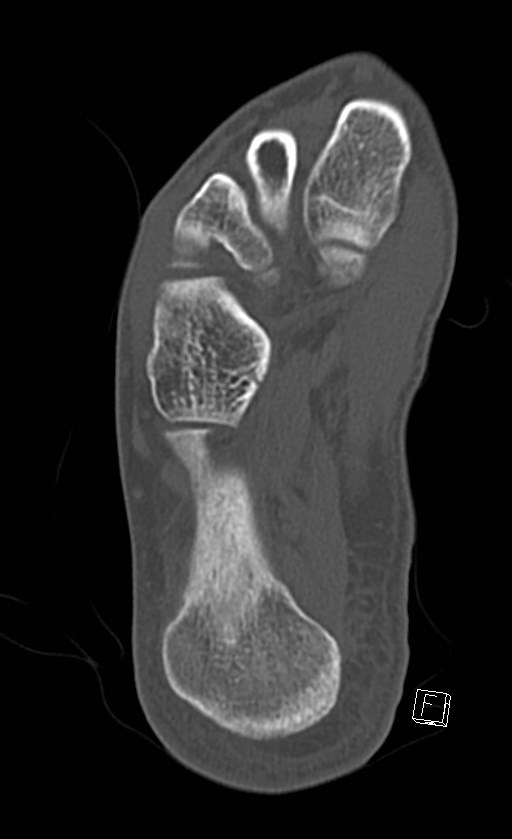 Normal CT of the ankle (Radiopaedia 47111-51658 Axial bone window 81).jpg