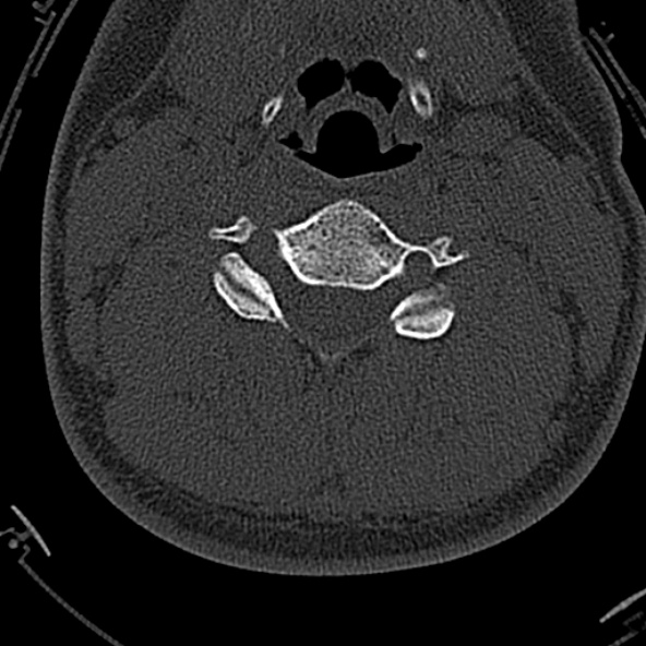 File:Normal CT of the cervical spine (Radiopaedia 53322-59305 Axial bone window 138).jpg