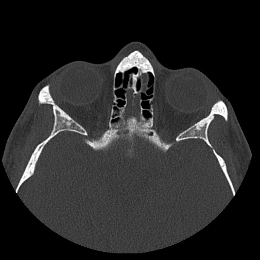 Normal CT paranasal sinuses (Radiopaedia 42286-45390 Axial bone window 40).jpg
