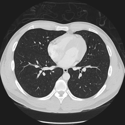 Normal CT pulmonary veins (pre RF ablation) (Radiopaedia 41748-44702 Axial lung window 33).png
