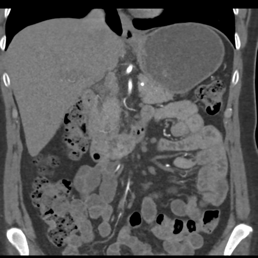 File:Normal CT renal artery angiogram (Radiopaedia 38727-40889 B 35).png