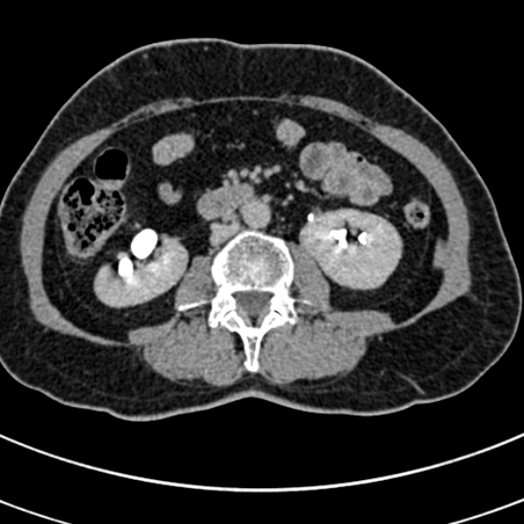 File:Normal CT split bolus study of the renal tract (Radiopaedia 48631-53634 Axial split bolus 119).jpg