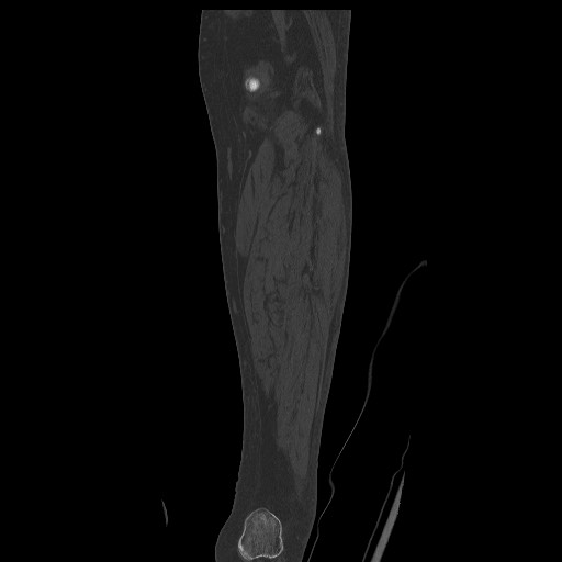 Normal CT tibia and fibula (Radiopaedia 51195-56848 Coronal non-contrast 49).jpg