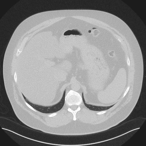 Normal HRCT (Radiopaedia 40797-43458 Axial lung window 56).png