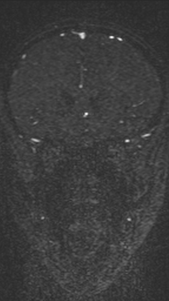 Normal MRI brain with MRV- teenager (Radiopaedia 49425-54553 Coronal MRV 89).jpg