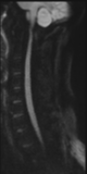 File:Normal MRI cervical spine (infection protocol) (Radiopaedia 53916-60039 Sagittal DWI 20).png