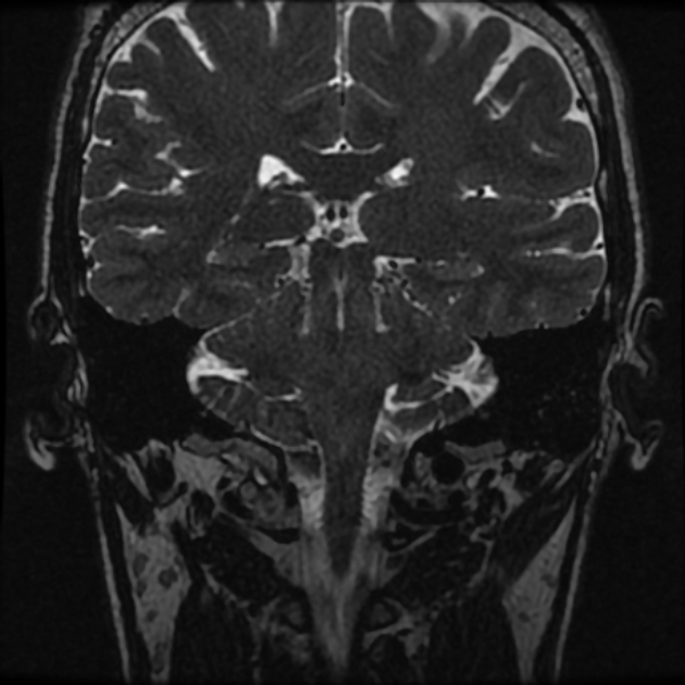 Normal MRI petrous (Radiopaedia 91317-108949 Coronal T2 73).jpg