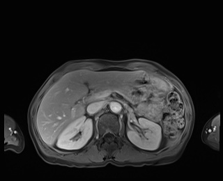 Normal adrenal glands MRI (Radiopaedia 82017-96004 M 31).jpg