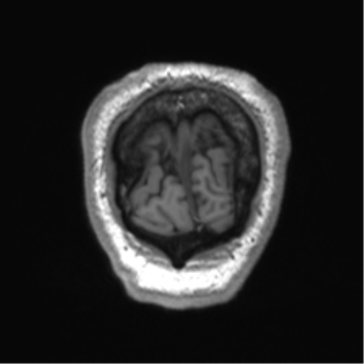 Normal brain MRI (non-focal epilepsy protocol) (Radiopaedia 53917-60040 Coronal T1 7).png
