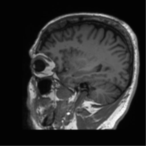 Normal brain MRI (non-focal epilepsy protocol) (Radiopaedia 53917-60040 Sagittal T1 17).png