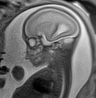 Normal brain fetal MRI - 22 weeks (Radiopaedia 50623-56050 Sagittal T2 Haste 8).jpg