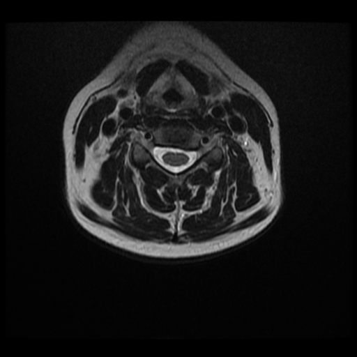 File:Normal cervical and thoracic spine MRI (Radiopaedia 35630-37156 Axial T2 19).png