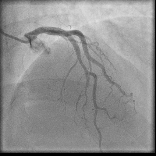 Normal coronary angiogram (DSA) (Radiopaedia 63081-71571 E 37).jpg