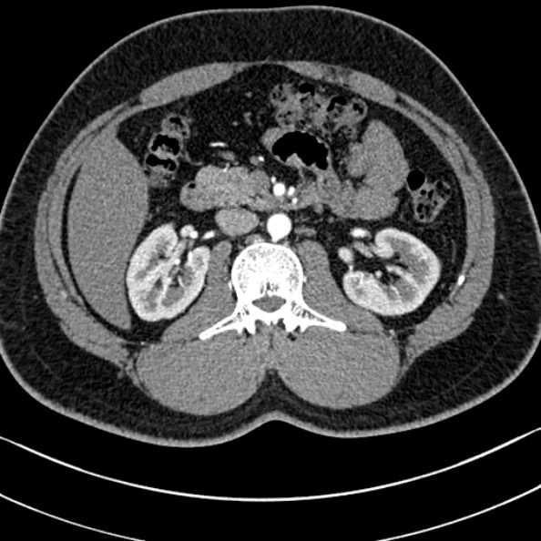 Normal kidneys on 4-phase CT study (Radiopaedia 25889-26038 B 39).jpg