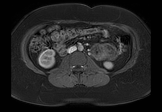 Normal liver MRI with Gadolinium (Radiopaedia 58913-66163 J 5).jpg