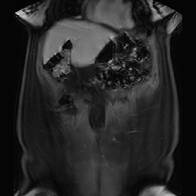 Normal liver MRI with Gadolinium (Radiopaedia 58913-66163 P 20).jpg