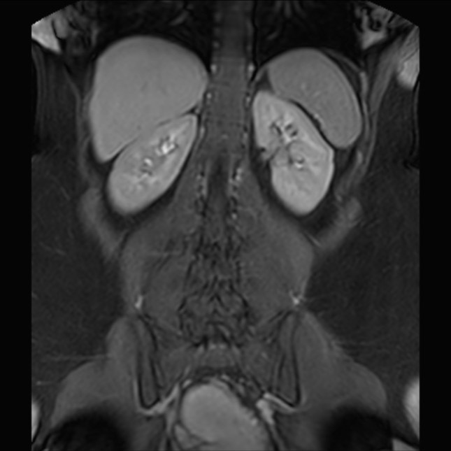 Normal liver MRI with Gadolinium (Radiopaedia 58913-66163 P 63).jpg