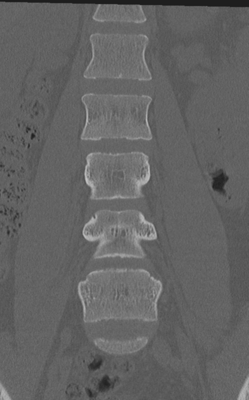 Normal lumbar spine CT (Radiopaedia 46533-50986 Coronal bone window 31).png
