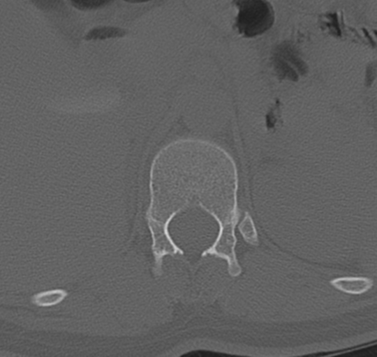 File:Normal lumbosacral CT (Radiopaedia 37923-39867 Axial bone window 20).png