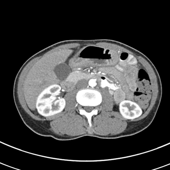 File:Normal multiphase CT liver (Radiopaedia 38026-39996 B 41).jpg