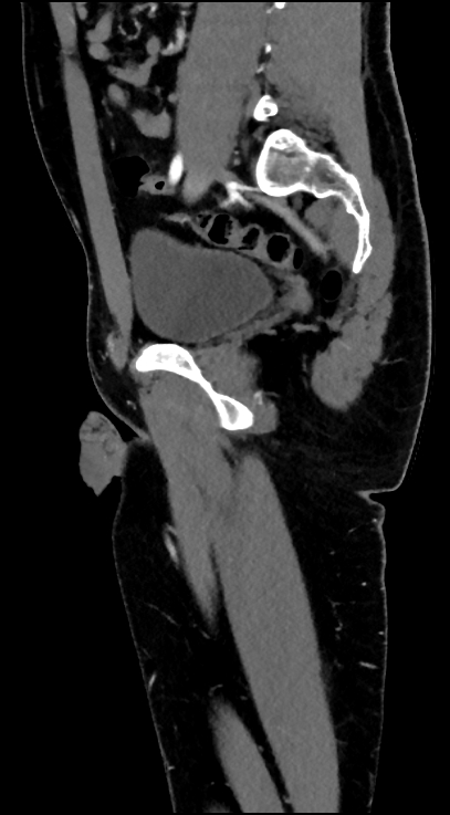 Normal pelvis CT angiogram (Radiopaedia 84966-100481 C 45).jpg