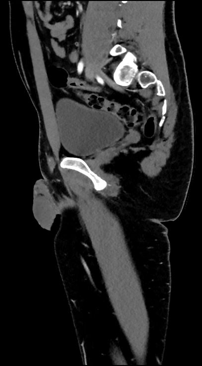 Normal pelvis CT angiogram (Radiopaedia 84966-100481 C 47).jpg