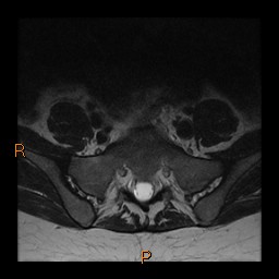 File:Normal spine MRI (Radiopaedia 77323-89408 Axial T2 27).jpg