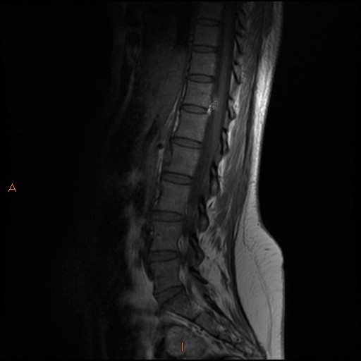 File:Normal spine MRI (Radiopaedia 77323-89408 Sagittal T1 6).jpg