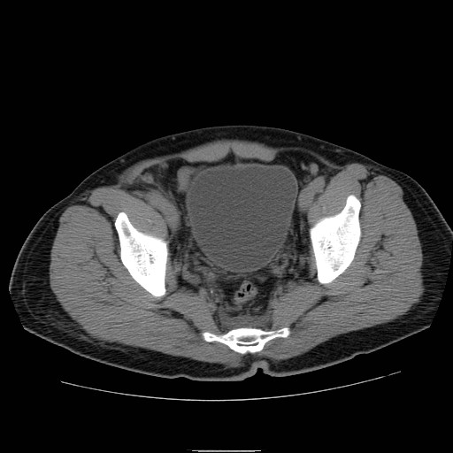 File:Obstructed kidney with perinephric urinoma (Radiopaedia 26889-27066 Axial non-contrast 59).jpg