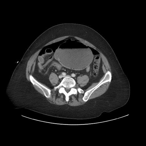 Obstructive distal colonic adenocarcinoma causing cecal perforation (Radiopaedia 86830-102989 A 135).jpg