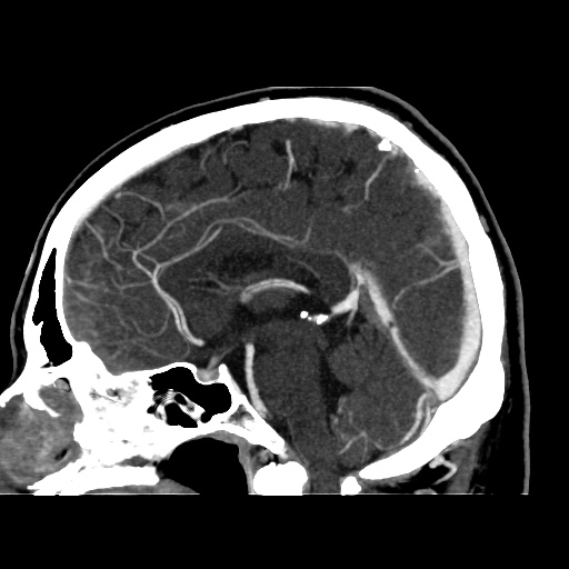 Occipital extradural hematoma simulating venous sinus thrombosis (Radiopaedia 46514-50964 D 39).jpg
