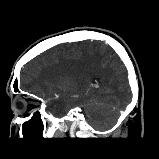 Occipital extradural hematoma simulating venous sinus thrombosis (Radiopaedia 46514-50964 D 52).jpg