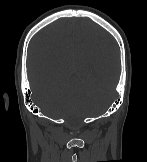 Occipital spur and Currarino type A atlas anomaly (Radiopaedia 87027-103285 Coronal bone window 108).jpg