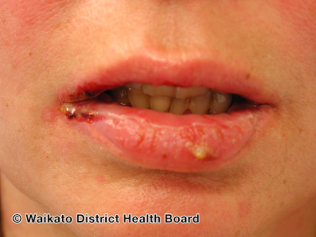 File:Oral pemphigus (DermNet NZ pemphigus-lips-019).jpg