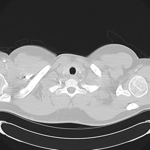 'Bovine' aortic arch (Radiopaedia 33554-34637 Axial lung window 4).png
