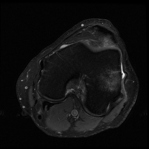 File:ACL and meniscal tears (Radiopaedia 79604-92797 Axial PD fat sat 12).jpg