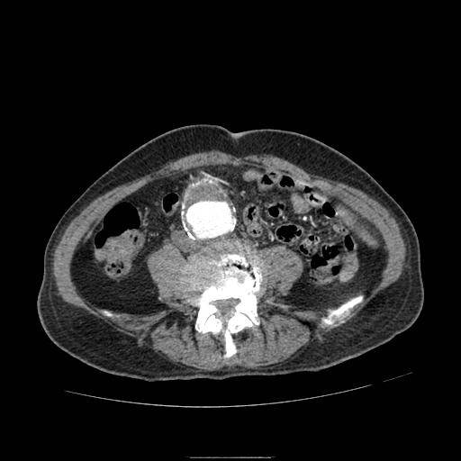 Abdominal aortic aneurysm (Radiopaedia 13341-13340 Axial C+ arterial phase 138).jpg