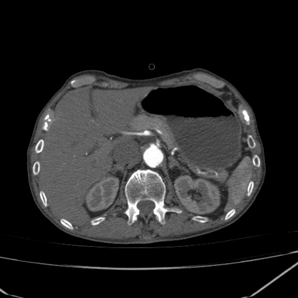 Abdominal aortic aneurysm (Radiopaedia 23703-23856 Axial C+ arterial phase 15).jpg