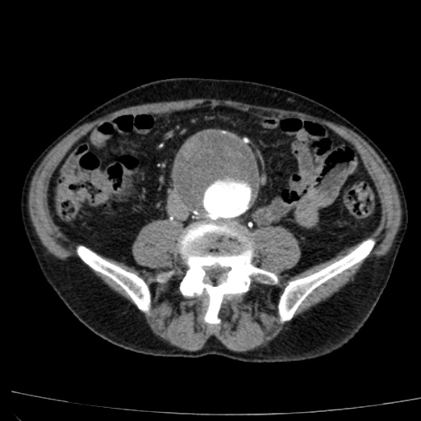 Abdominal aortic aneurysm (Radiopaedia 29248-29660 Axial C+ arterial phase 53).jpg
