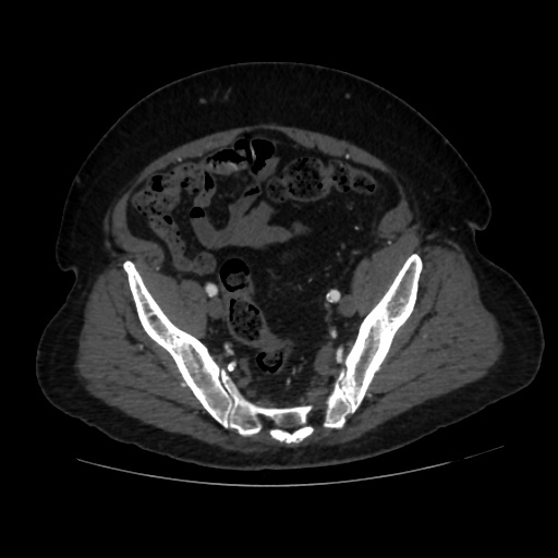 File:Abdominal aortic aneurysm (Radiopaedia 57318-64259 Axial C+ arterial phase 61).jpg