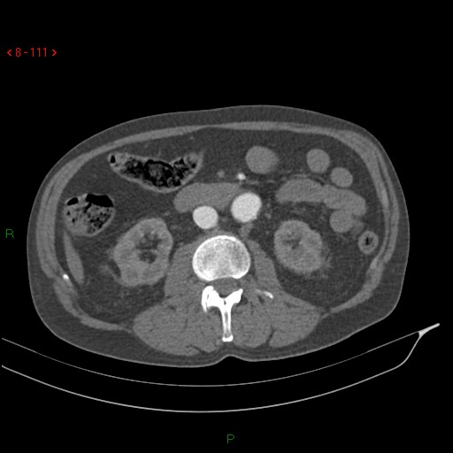 Abdominal aortic aneurysm rupture with aortocaval fistula (Radiopaedia 14897-14841 Axial C+ arterial phase 111).jpg