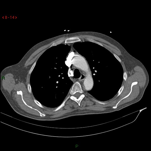 Abdominal aortic aneurysm rupture with aortocaval fistula (Radiopaedia 14897-14841 Axial C+ arterial phase 14).jpg
