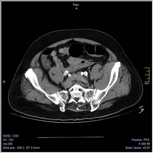 Abdominal aortic aneurysm with thrombus fissuration (Radiopaedia 47340-51926 Axial C+ arterial phase 50).jpg