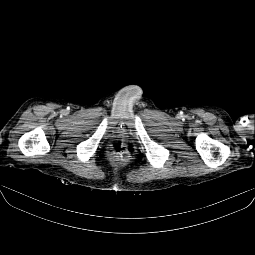File:Abdominal collection due to previous cecal perforation (Radiopaedia 80831-94320 Axial C+ portal venous phase 223).jpg