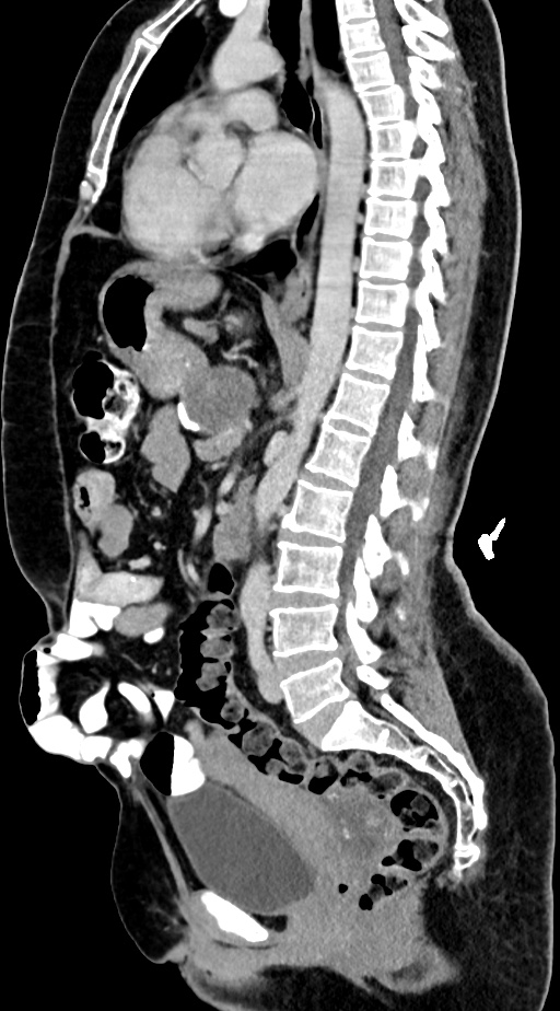 Abdominal hydatid disease (Radiopaedia 68223-77737 Sagittal C+ portal venous phase 34).jpg