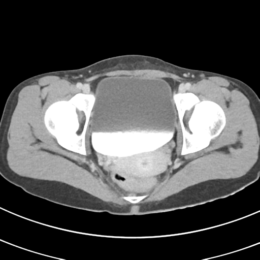 File:Abdominal multi-trauma - devascularised kidney and liver, spleen and pancreatic lacerations (Radiopaedia 34984-36486 Axial C+ delayed 75).png