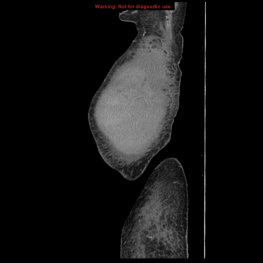 Abdominal wall hematoma (Radiopaedia 9427-10112 Sagittal C+ portal venous phase 107).jpg