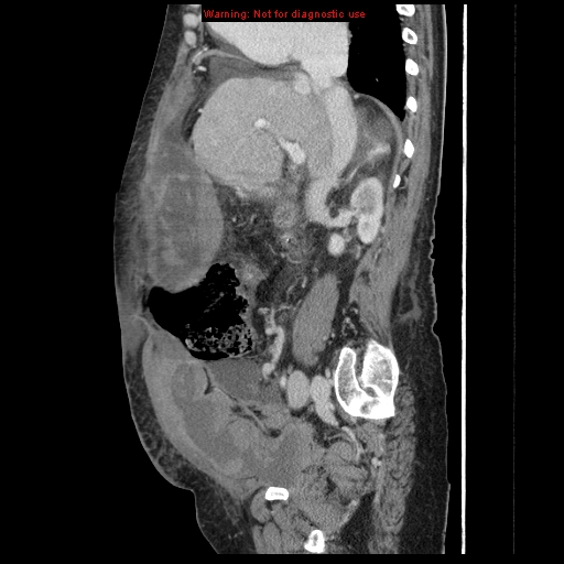 Abdominal wall hematoma (Radiopaedia 9427-10112 Sagittal C+ portal venous phase 67).jpg