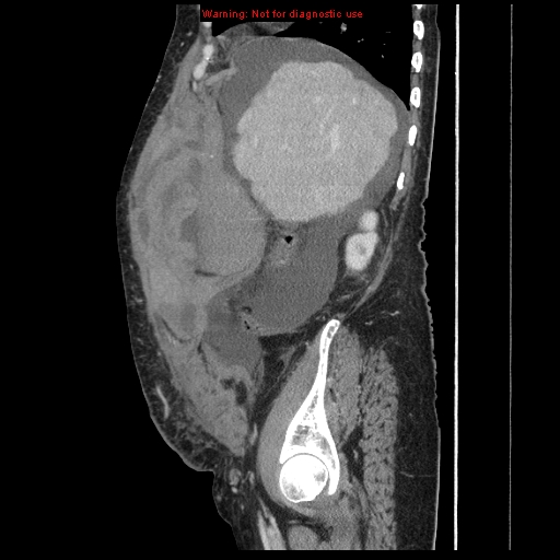 File:Abdominal wall hematoma (Radiopaedia 9427-10112 Sagittal C+ portal venous phase 81).jpg